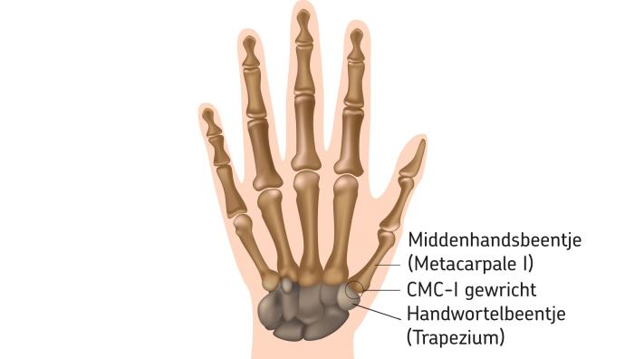 Artrose van de duim | Jeroen Bosch Ziekenhuis